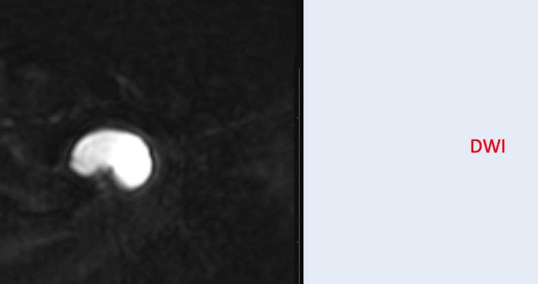 Figure 3 for case Ganglion cyst
